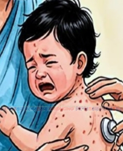ফরিদপুরে নতুন ২৫ জন হাম রোগী শনাক্ত, মোট আক্রান্ত ২ হাজার ৬৯৭